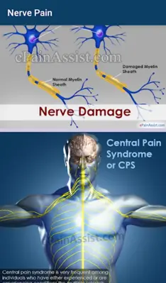 Nerve Pain android App screenshot 2