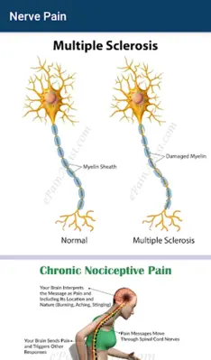 Nerve Pain android App screenshot 3